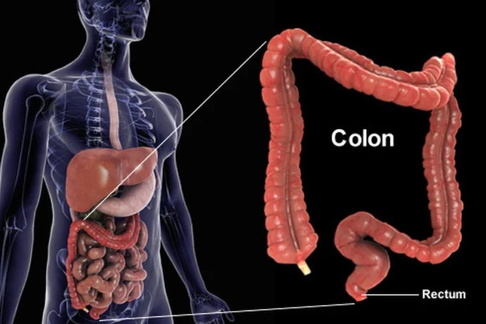 Uncovering the Truth About Colon Cancer: Prevention, Detection, and Hope