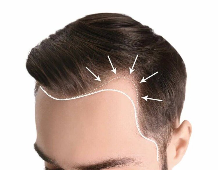 Hair Transplant in Dubai: Transform Your Hairline